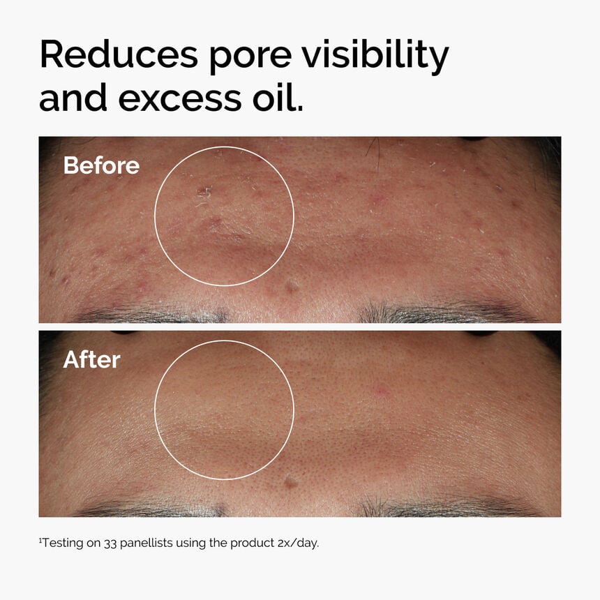 ord-niacinamide-zinc-blemish-serum-before-after-pores