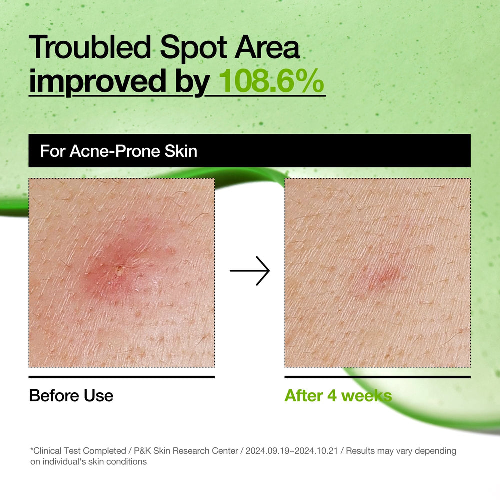 anua-us-ampoule-serum-azelaic-acid-10-hyaluron-redness-soothing-serum-1161173132